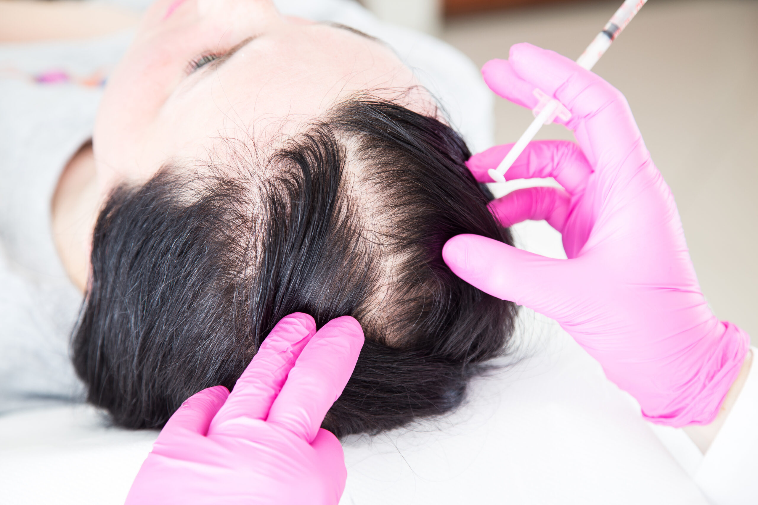 How PRP Helps with Hair Loss